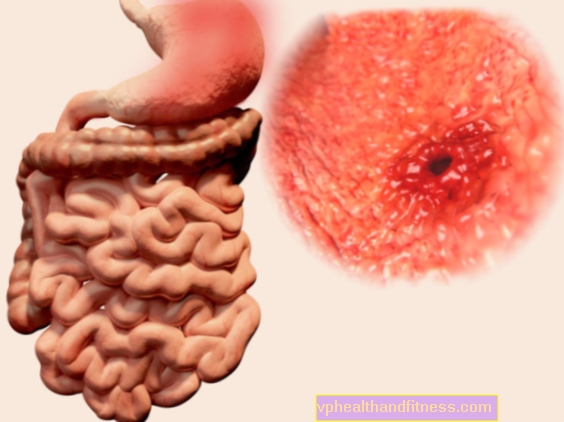 Úlceras de estómago: síntomas y tratamiento