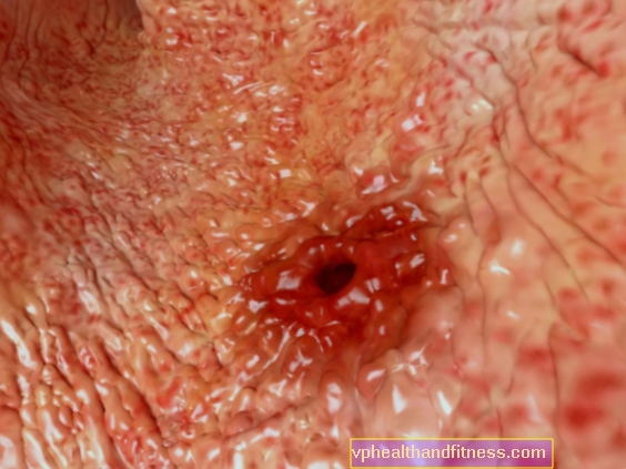 Salud - Úlceras de estómago: las verdades y mitos que circulan sobre la úlcera gástrica
