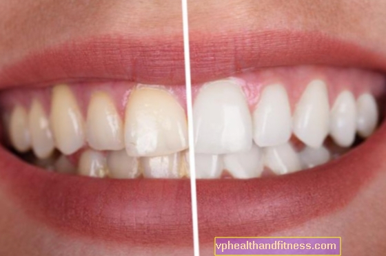 Hampaiden valkaisu: 6 tapaa pitää hampaasi valkoisena