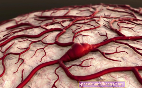 Trastornos de la circulación sanguínea en el cerebro: causas y síntomas.