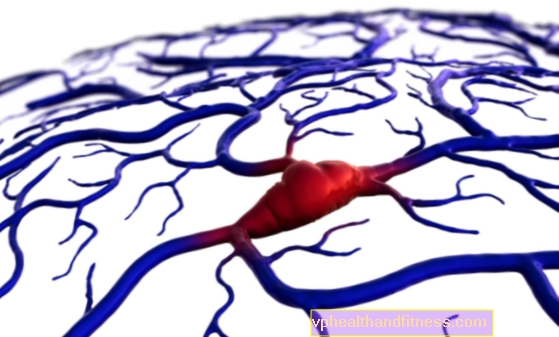 Smegenų venų sinusų trombozė: priežastys, simptomai, gydymas