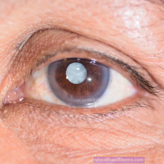 Katarakt - farlig grumling av ögonlinsen. Underskatta inte grå starr