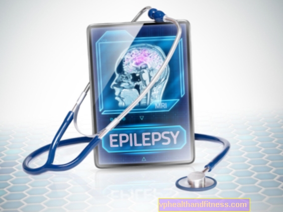 Epilepsisyndromer: typer