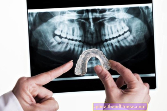 Broušení zubů nebo BRUSISMUS. Příčiny, příznaky, léčba