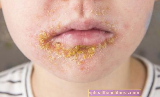 Cambios en la boca (granos, bultos, burbujas). 8 causas más comunes 